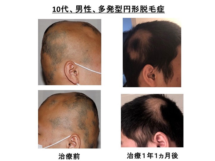円形脱毛症　病院